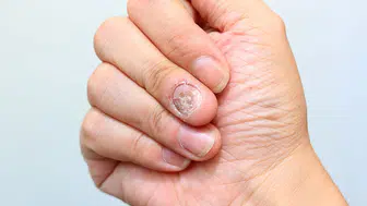 El ve tırnaklarda mantar nedir? Neden olur? Nasıl geçer?