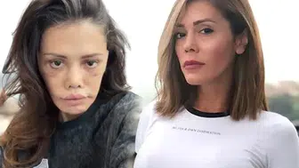 Yüz Nakli Sonrası Didem Ceran'dan Şaşırtıcı Dönüşüm!
