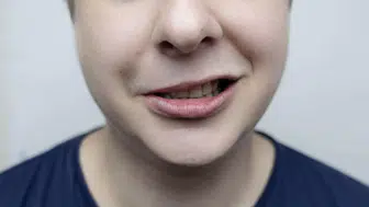 Yüz Felci Belirtileri Nelerdir? Ne Zaman Hastaneye Gidilmeli?