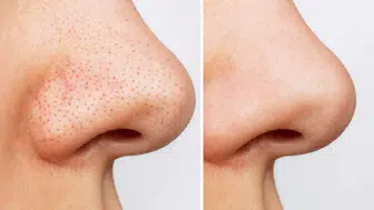 Siyah Noktaları Yok Etmenin Etkili Yolları!