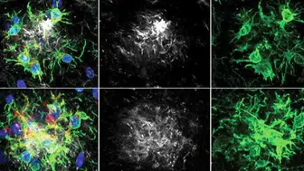 Alzheimer'da ezber bozan gelişme: Beynin yorgun savunma hattı yeniden ayağa kaldırıldı