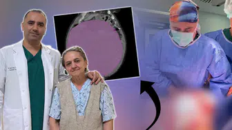 Karnındaki şişliği kabızlık sanmıştı: 22 kiloluk kütle hayatını kabusa çevirdi