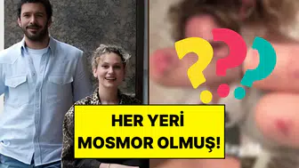 Korku filmi setinde zor anlar: Farah Zeynep Abdullah vücudundaki morlukları takipçilerine gösterdi