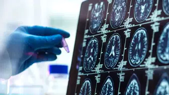 Hafızanızı korumanın anahtarı 50’li yaşlarda saklı olabilir: Alzheimer’ın sessiz başlangıcı