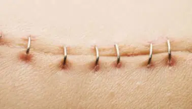 İltihaplı Dikişler: Tanım ve İyileşme Sürecinin Adımları