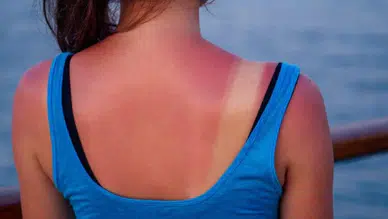 Güneş yanığına ne sürülmeli, ne sürülmemeli?  İşte evde uygulanabilecek acil yanık müdahaleleri