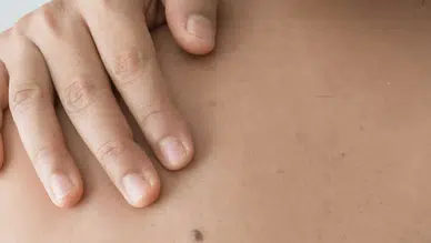 Cilt kanserinden nasıl korunuruz? İşte cilt kanserinden korunmanın yolları!
