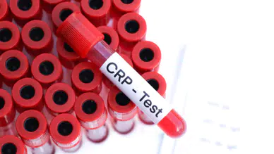 CRP nefelometrik nedir, nefelometrik kaç olursa tehlikeli?