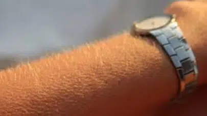 Tüyler Neden Diken Diken Olur?  Bilimsel Gerçek Şaşırttı