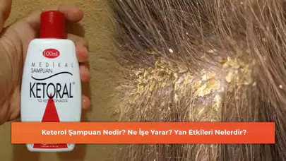 Keterol Şampuan Hakkında Bilinmesi Gerekenler: İşlevleri ve Olası Yan Etkileri