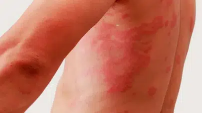 Belirtilerden Tedaviye Kapsamlı Zona Hastalığı Rehberi