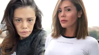 Yüz Nakli Sonrası Didem Ceran'dan Şaşırtıcı Dönüşüm!