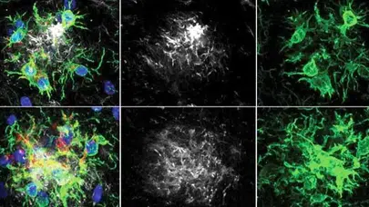 Alzheimer'da ezber bozan gelişme: Beynin yorgun savunma hattı yeniden ayağa kaldırıldı