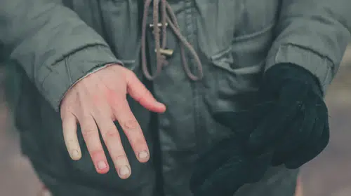 Raynaud Fenomeni (Hastalığı) Nedir? Parmak Uçlarında Beyazlama ve Üşüme Neden Olur? Belirtileri, Testi ve Tedavisi