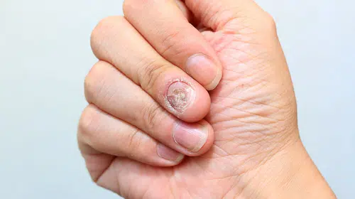 El ve tırnaklarda mantar nedir? Neden olur? Nasıl geçer?