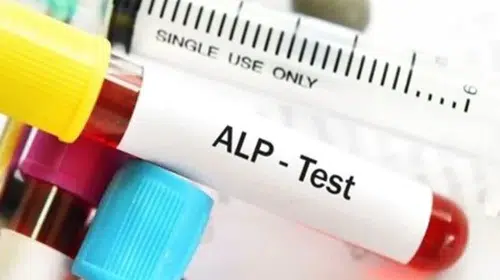 Alkalen Fosfataz: Anlamı ve Yüksek-Düşük Değerlerin Önemi