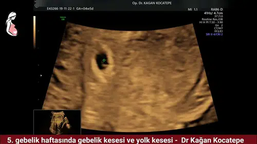 Gebelik Kesesi Kaç mm iken Kalp Atışı Duyulur?