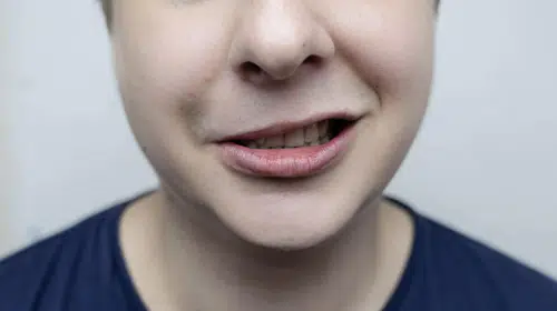 Yüz Felci Belirtileri Nelerdir? Ne Zaman Hastaneye Gidilmeli?