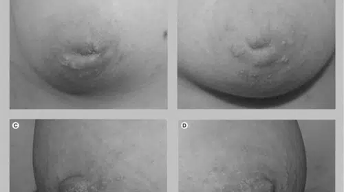 Emzikli Annelerin Sorununa Yenilikçi Çözüm: Meme Ucu Çıkartma Yöntemleri!