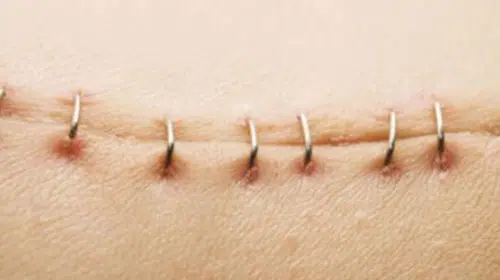 İltihaplı Dikişler: Tanım ve İyileşme Sürecinin Adımları