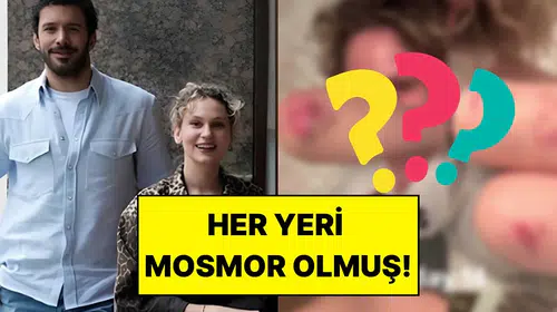 Korku filmi setinde zor anlar: Farah Zeynep Abdullah vücudundaki morlukları takipçilerine gösterdi