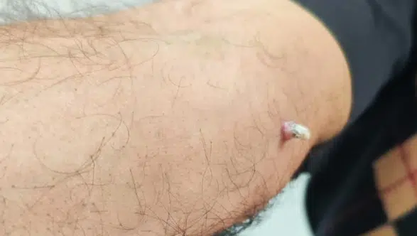 İhmal Edilen Cilt Yarası Kanser Teşhisiyle Sonuçlandı