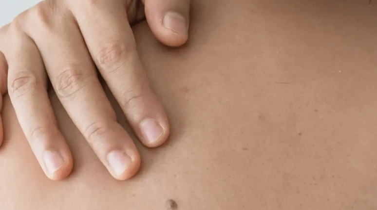 Cilt kanserinden nasıl korunuruz? İşte cilt kanserinden korunmanın yolları!