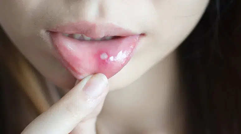 Aft Nedir ve Nasıl Geçer? İşte Etkili Çözüm Yolları!